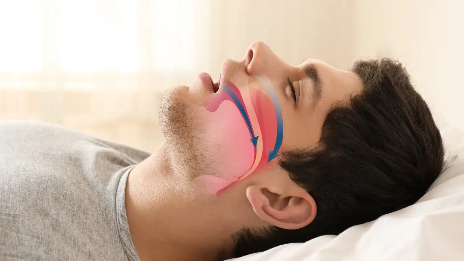 Man sleeping with mouth open showing airflow obstruction and sleep apnea illustration