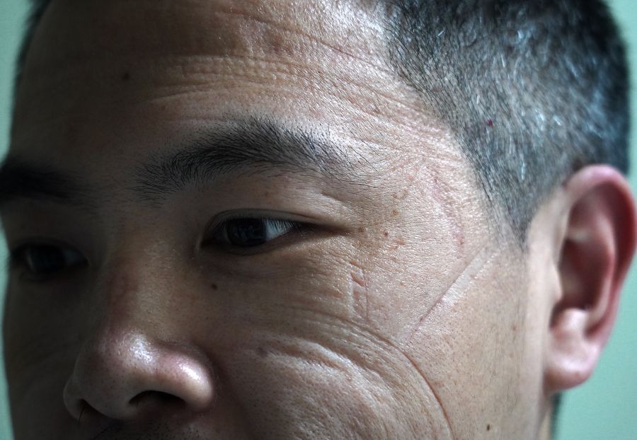 Mask Marks on Face: Cushion Types Compared